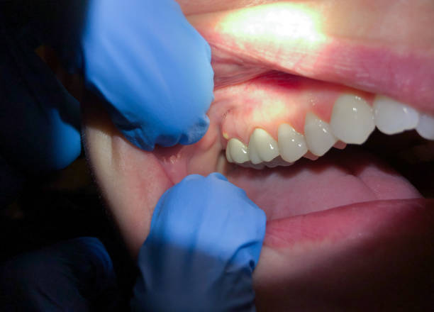 Best Dental Abscess Treatment in Florissant, MO